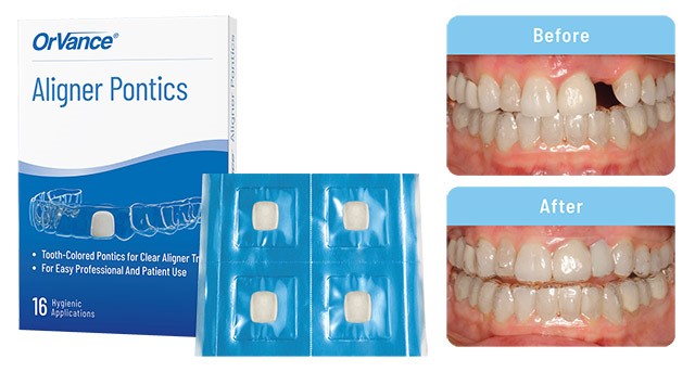 First Aligner Pontics Image