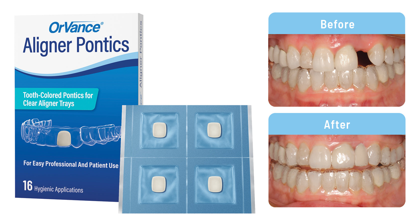 OrVance Aligner Pontics Preferred by Practices According to New Whitepaper