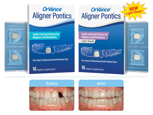 OrVance® Aligner Pontics: The Premier Solution for Clear Aligners and Retainers