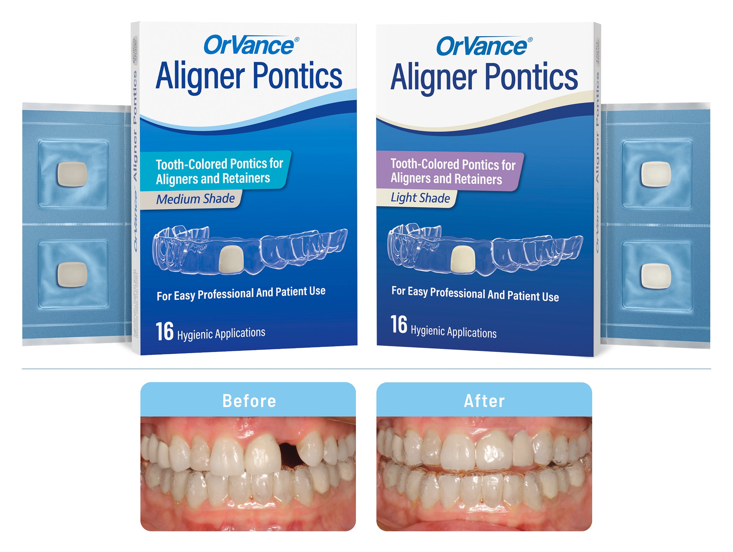 OrVance® Aligner Pontics