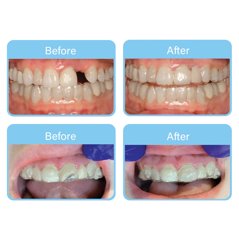 OrVance Aligner Pontics - 16 Count