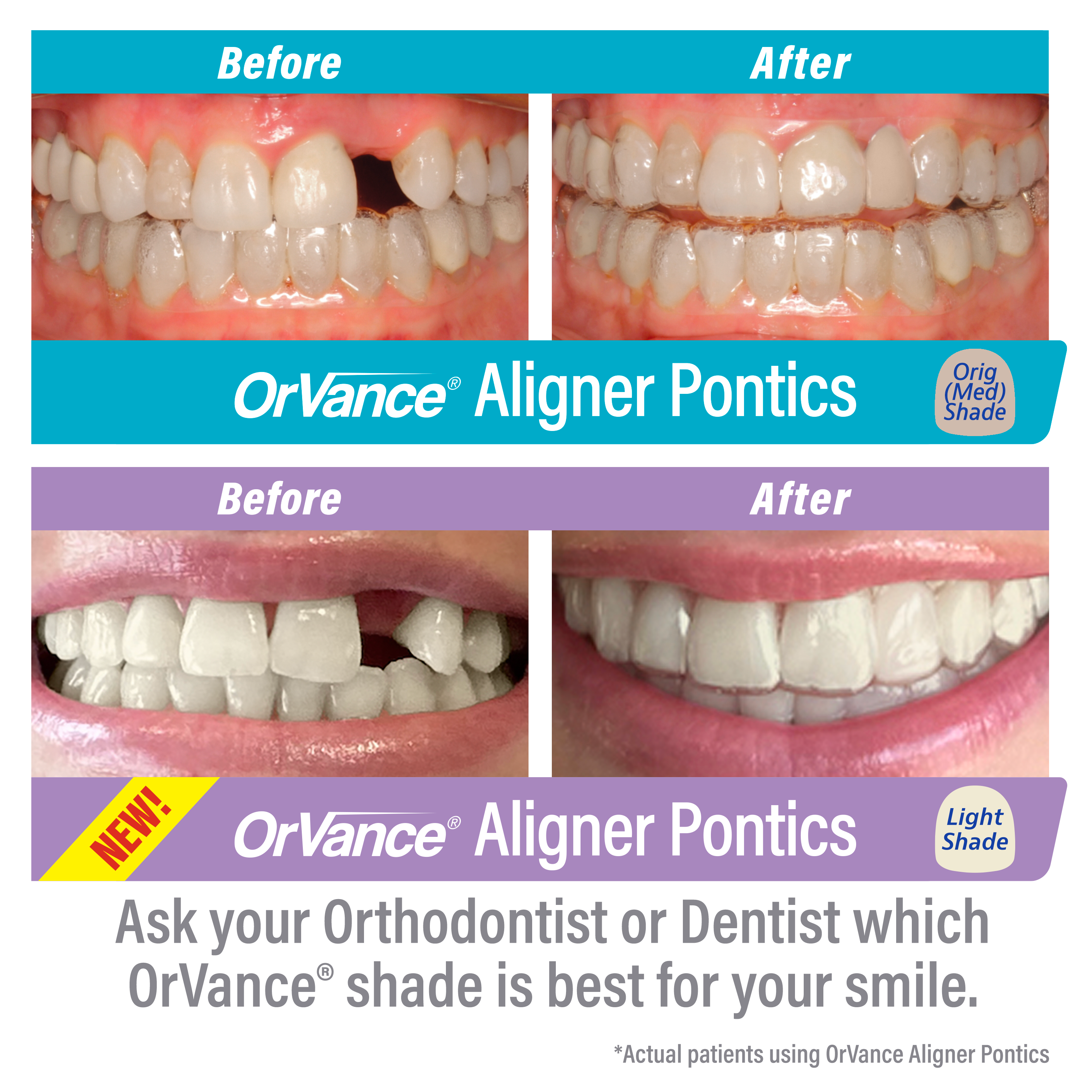 OrVance® Aligner Pontics