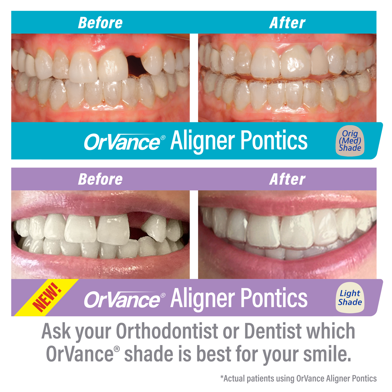 OrVance Aligner Pontics - 16 Count